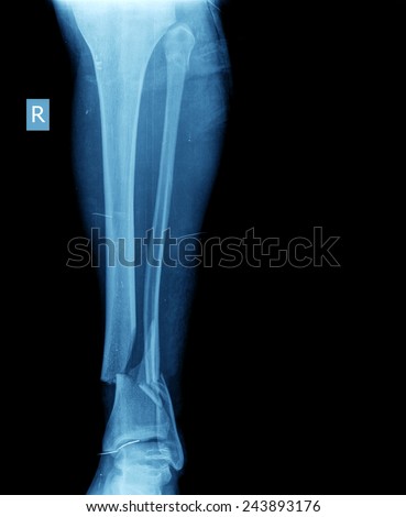 broken leg xray