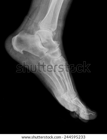 xray of foot by side view
