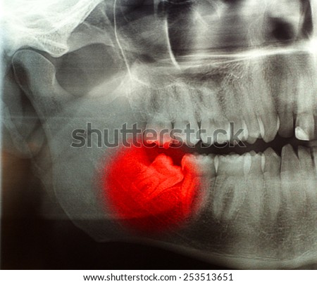 X-ray, panoramic RTG , radiology, photo showing skew wisdom tooth (eight tooth) for removal - negative effect