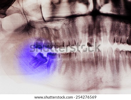 X-ray, panoramic RTG , radiology, photo showing skew wisdom tooth (eight tooth) for removal - black and white