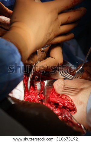 Surgeon use special surgical instruments to cut off cartilaginous excrescence