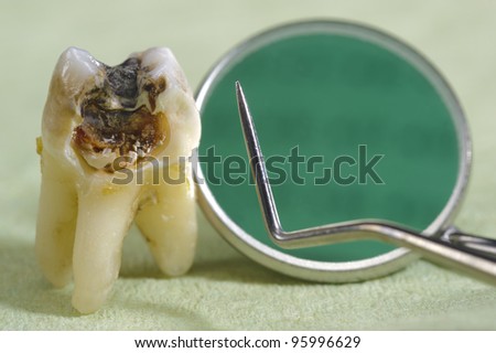 extracted tooth with dental caries