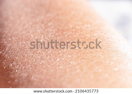 Concept of extremely dry and dehydrated skin of the body. Problematic skin diagnosed with xerosi or dermatitis. Close up of chapped arms and legs. Selective focus of a itchy skin. Foto d'archivio © 