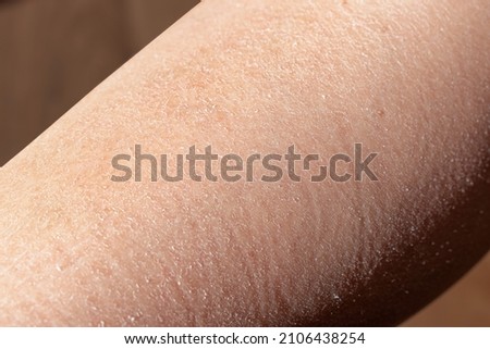 Concept of extremely dry and dehydrated skin of the body.  Close up of chapped arms and legs. Selective focus of a itchy skin. Diagnosis of xerosi, dermatitis, flaking skin.  Foto d'archivio © 