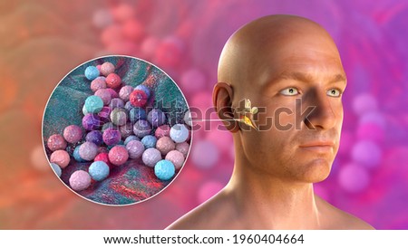 Staphylococcus aureus bacterium as a cause of otitis media. 3D illustration showing purulent inflammation of the middle ear in a male person and close-up view of staphylococci bacteria Stock fotó © 