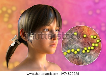 Streptococcus bacterium as a cause of otitis media. 3D illustration showing purulent inflammation of the middle ear in a girl and close-up view of streptococci bacteria Stock fotó © 