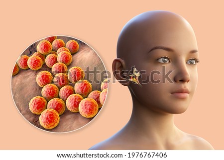 Staphylococcus aureus bacterium as a cause of otitis media. 3D illustration showing purulent inflammation of the middle ear in a girl and close-up view of staphylococci bacteria Stock fotó © 