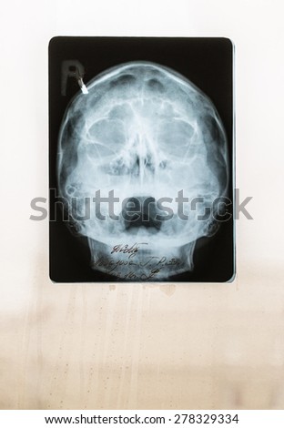 Closeup of a childs skull x-ray on a misty window