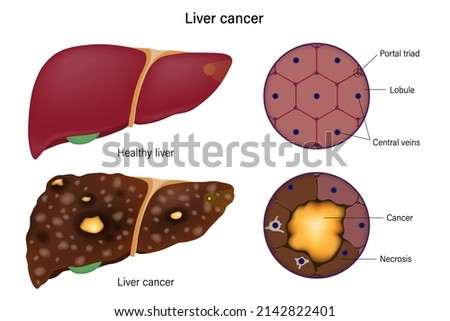 Liver histology. Normal liver and liver cancer. Liver disease for medical education and science. 