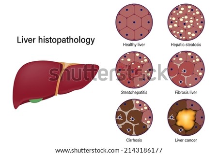 Liver histopathology. Healthy liver, Hepatic steatosis, Steatohepatitis, Fibrosis liver, Cirrhosis and Liver cancer.