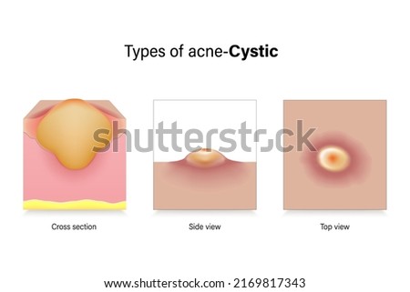 Types of acne. Skin problems. Cystic in cross section, side view and top view. Vector for advertising about beauty and medical treatment.