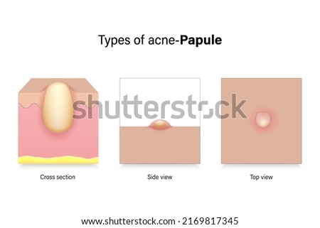 Types of acne. Skin problems. Papule in cross section, side view and top view. Vector for advertising about beauty and medical treatment.