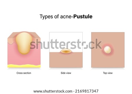 Types of acne. Skin problems. Pustule in cross section, side view and top view. Vector for advertising about beauty and medical treatment.