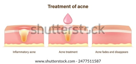 Treatment of acne. Skin layers before, during and after treatment. Acne skin and healthy skin. Treating acne with acne serum.