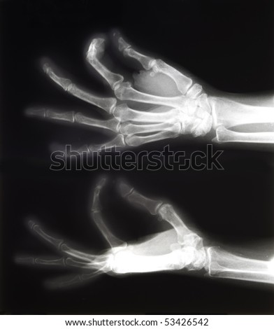 X-ray of both human hands, space for copy