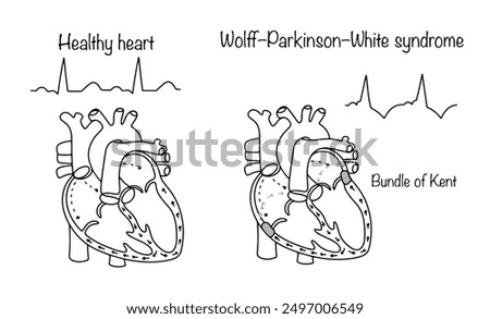 A congenital anomaly of the heart structure, in which a person has an additional myocardial conduction system. Drawn healthy heart and the heart of a sick person. Wolff–Parkinson–White syndrome.