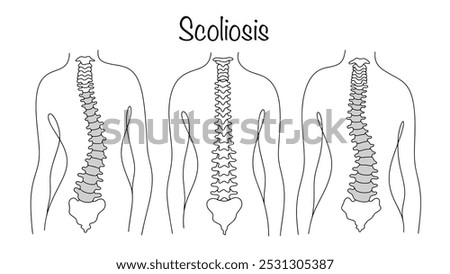 Scoliosis. Curvature of the spinal column relative to its axis. A man with a healthy back and a man with scoliosis. Line drawn illustration on a medical theme. Vector.