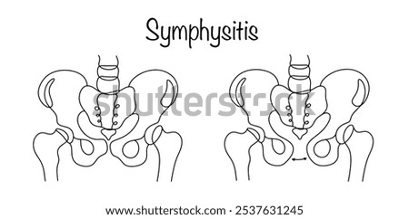 Separation of the pubic bones during pregnancy or labor. Anatomically correct pelvis and pelvis of a person with symphysitis. Line drawn medical illustration on a white background.