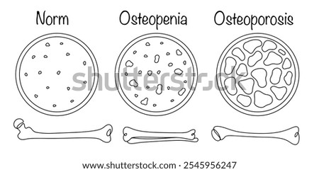 Osteopenia and osteoporosis. A condition in which there is a diffuse decrease in the volume of bone mass in the body. Hand-drawn normal bone structure and bone tissue in disease. Isolated vector.