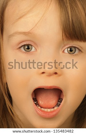 Girl with a mouthful of metal dental crowns