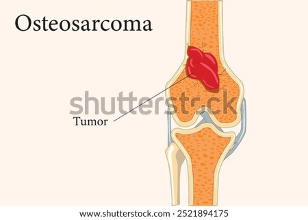 Split bone revealing an osteosarcoma tumor inside, highlighting malignant growth and bone pathology. cross section. eps 10