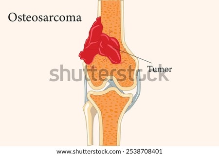 Split bone revealing an osteosarcoma tumor inside, highlighting malignant growth and bone pathology. cross section. eps 10