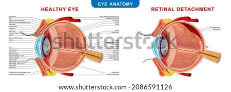 Retinal Detachment, anatomical diagram of the eye. Medicinal educational information. Vector illustration.