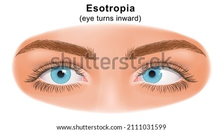 Squint eye (Strabismus). Esotropia, eye turns inward. Deflection of visual axes. Vector illustration. Сток-фото © 