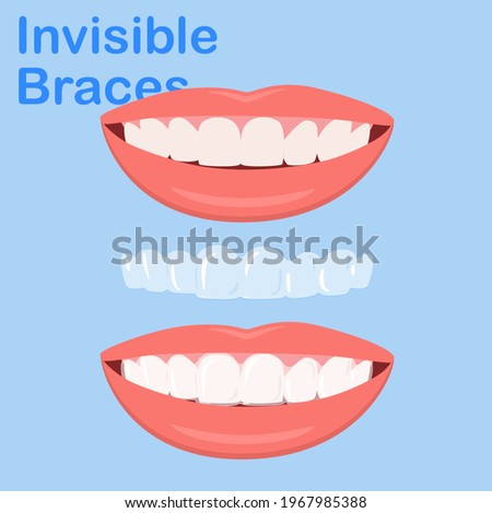 Woman wearing orthodontic silicone trainer. Invisible braces aligner. invisalign braces or invisible retainer. beautiful smile.