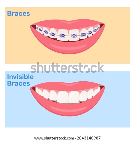 Types of Dental. Smiling white teeth and pink lips. Ceramic, Colors braces. Smile With Braces. wearing orthodontic silicone trainer. Invisible braces aligner. invisalign. removable braces.