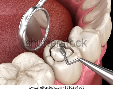 Decayed tooth restoration with composite filling. Medically accurate tooth 3D illustration. ストックフォト © 