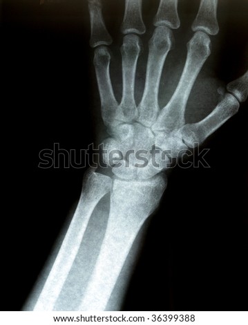 Xray of a wrist. Some film grain visible.