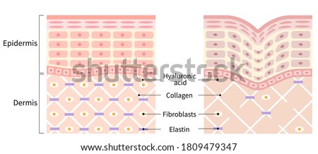 diagrams of young skin and winkle. young skin is firm tight, its collagen framework is healthy. old skin sags as it loses its support structure.