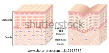 diagrams of young skin and winkle skin. young skin is firm tight, its collagen framework is healthy. old skin sags as it loses its support structure.
