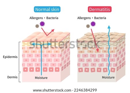 atopic dermatitis (eczema) dry and normal skin cell layer illustration. Healthy and beauty skin care concept Stock foto © 