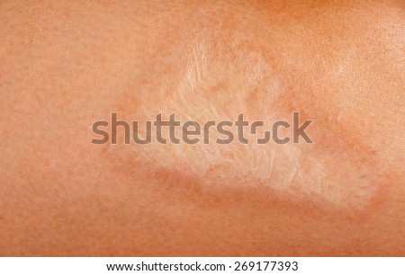 burn scar stock photo 57476164 large burn scar on the human stock photo 269177393 burn scar stock photo 57476164 large burn scar on the human stock photo 269177393