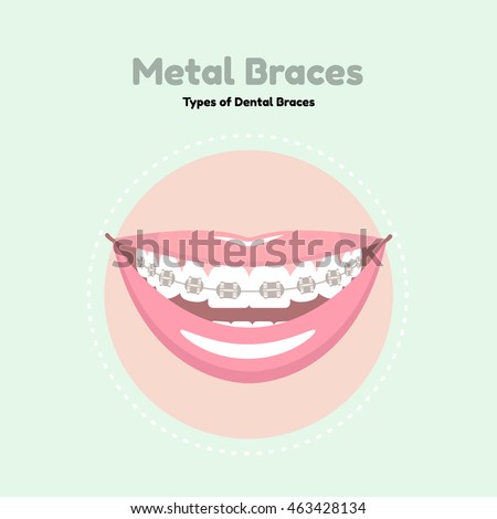 Metal Dental Braces. Types of Dental Braces. Vector flat illustration of smile with braces on the teeth. 