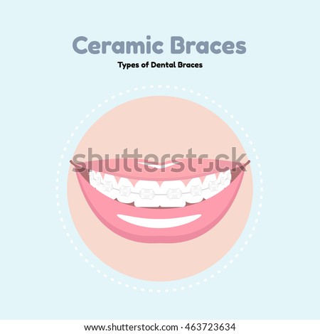 Types of Dental Braces. Vector flat illustration of smile with braces on the teeth. 