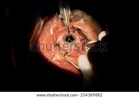 the implant of new artificial crystalline lens in cataract surgery Foto d'archivio © 