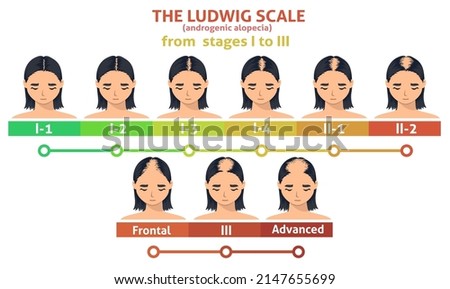 Ludwig scale of androgenic alopecia. Female balding progress poster. Hairloss problem infographic. Woman with hairloss symptom in three stage illustration