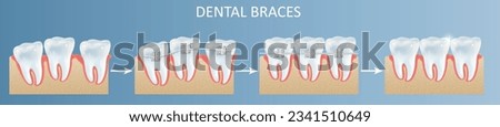Dental teeth braces installation steps vector poster illustration. Dental medicine , stomatology and tooth treatment concept
