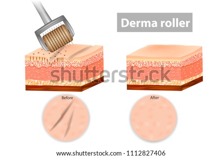 Derma roller or Meso-roller. Skin before and after application Roller for mesotherapy. Vector illustration