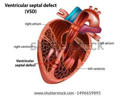 Ventricular septal defect (VSD).Congenital heart defect