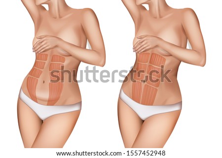 Diastasis recti or rectus abdominis diastasis