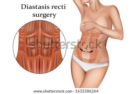 Diastasis  Recti  Surgery (stretching of the linea alba). Abdominoplasty