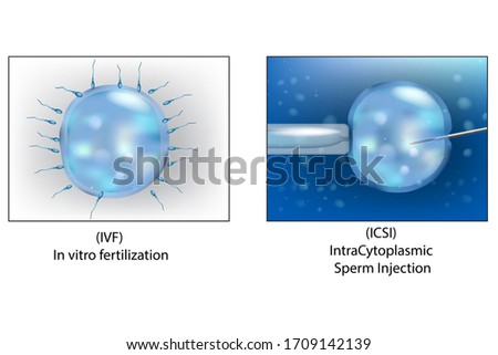 (ICSI) Intra Cytoplasmic Sperm Injection and (IVF) in vitro fertilization.