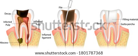Endodontic root canal treatment process. Dentistry, dental restoration concept. Tooth decay caries disease development