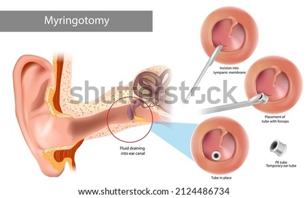 Paracentesis or myringotomy. Incision into tympanic membrane. Surgical procedure involving puncture of the tympanic membrane in order to evacuate the middle ear of pathological secretion.