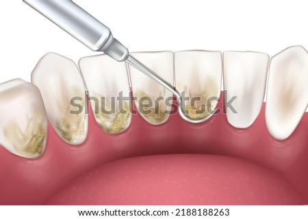Periodontal Scaling and Root Planing. Oral hygiene and conventional periodontal therapy.  Medically accurate of human teeth cleaning treatment. Dental scale.
