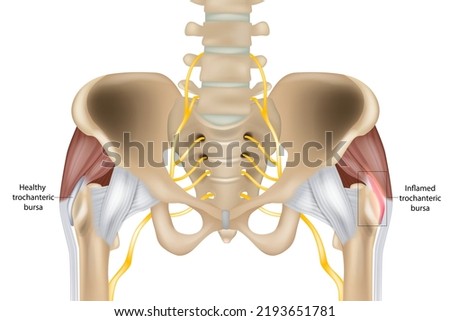 Hip Trochanteric bursitis is inflammation of the bursa. Illustration of the  Healthy and inflamed trochanteric bursa. Greater trochanteric pain syndrome. 